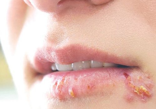 Tác hại của oral là gì?